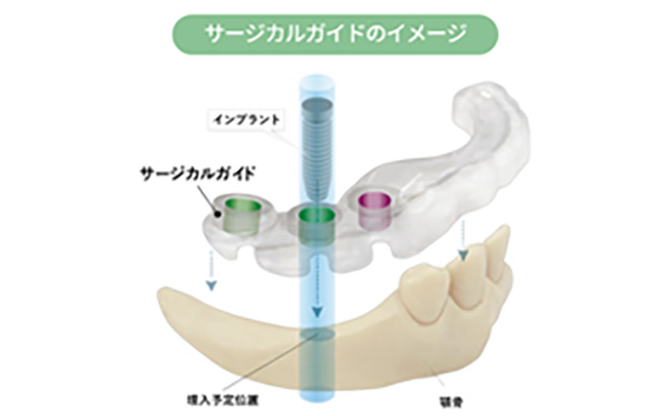 STEP.2 サージカルガイドを用いた手術